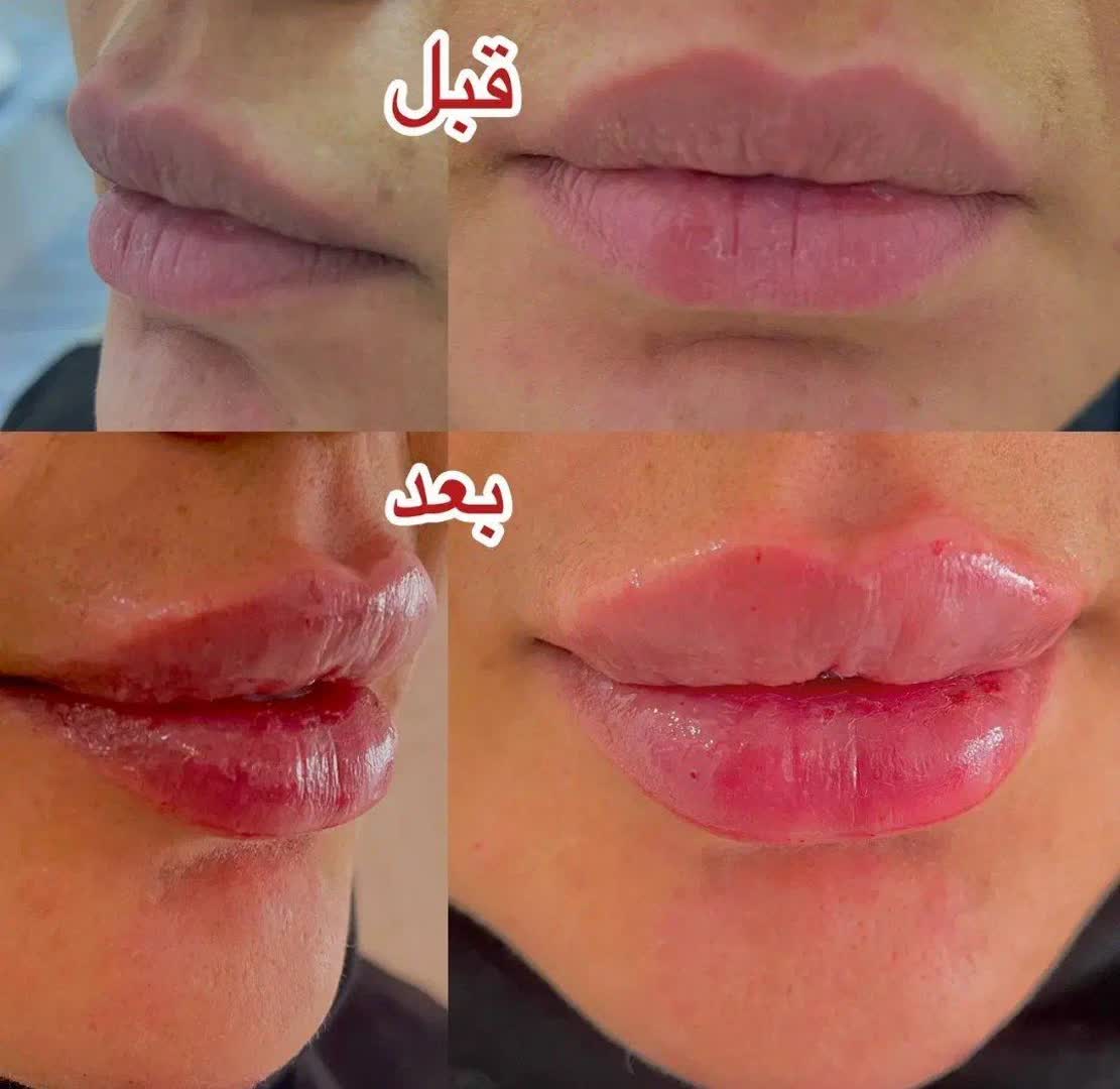 فیلر لب حرفه‌ای بانوان در شهر بهارستان اصفهان